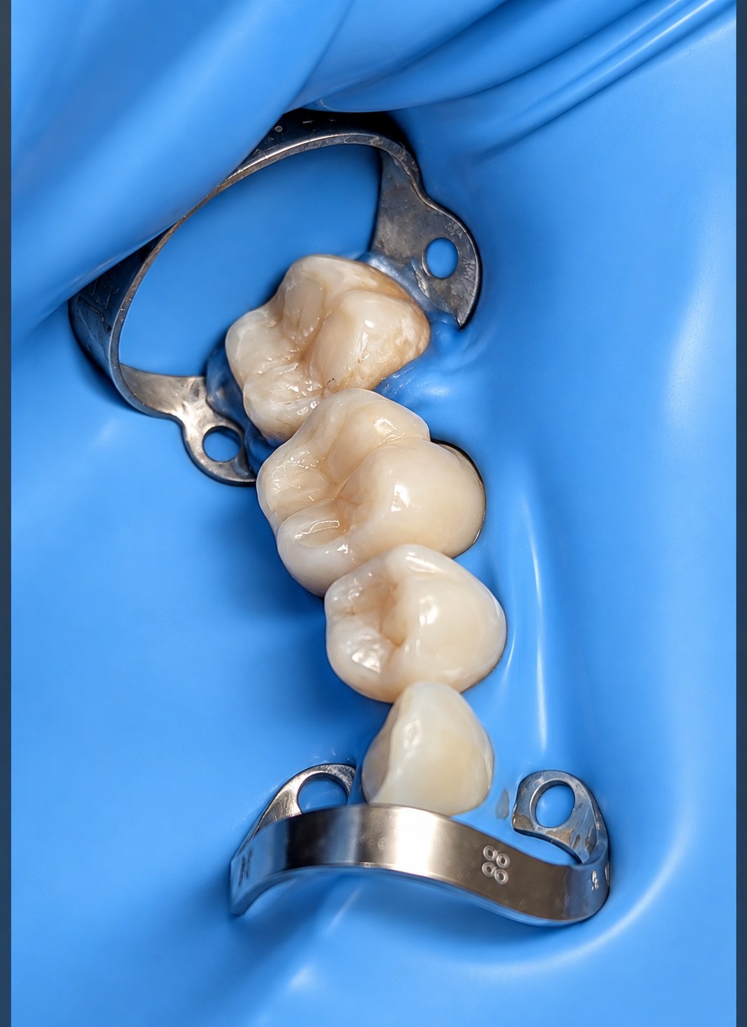 Después - Limpieza de Caries e Incrustación Estética