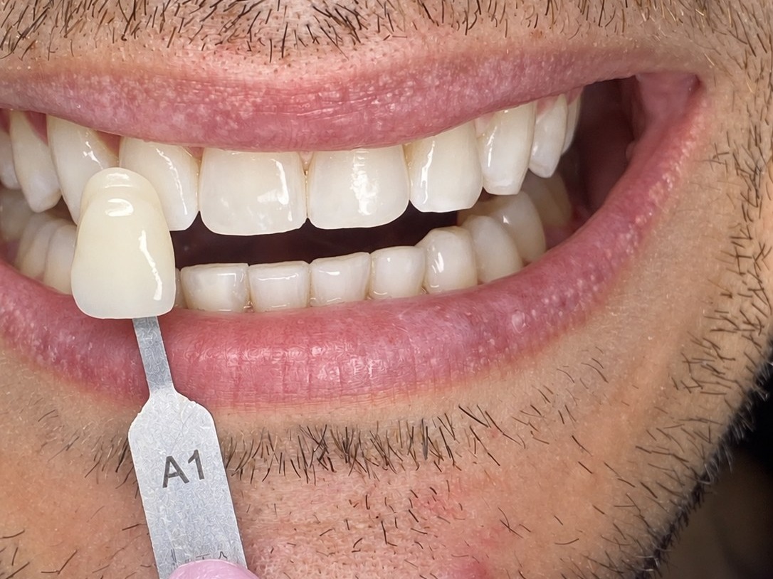 Después - Blanqueamiento Dental LED en Consultorio