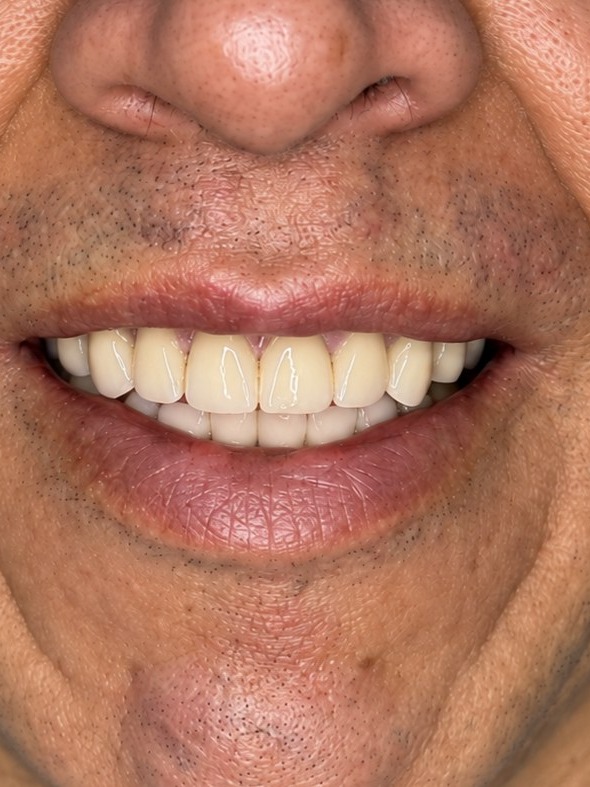 Después - Prótesis Estética de Alta Adaptabilidad